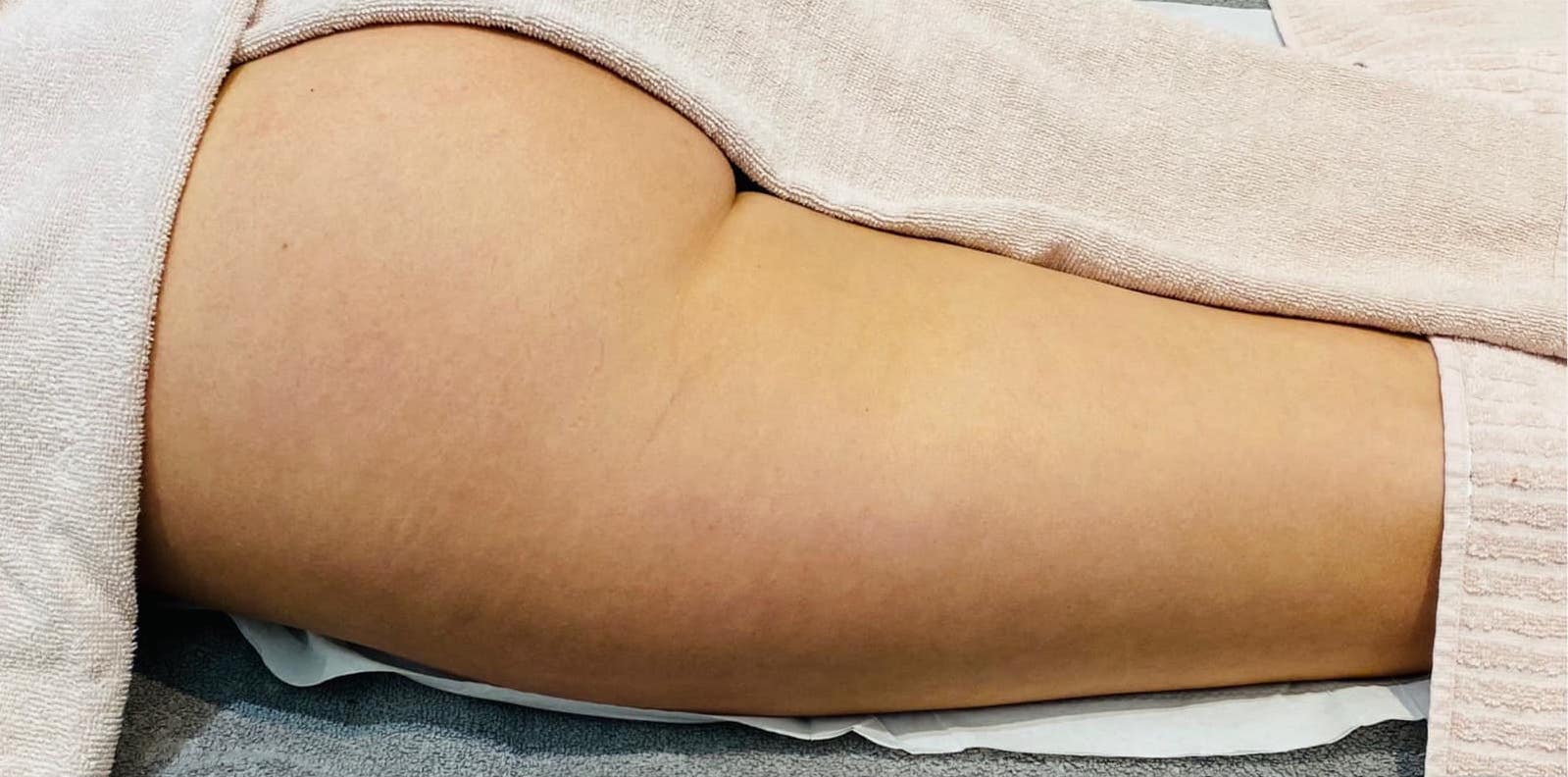 before and after collagen lift belle amie beauty boutique