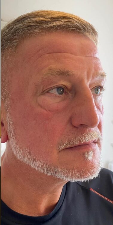 before and after collagen lift bespoke male grooming