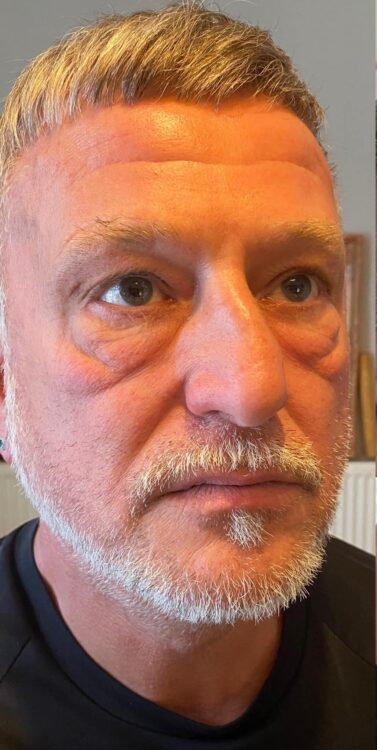 before and after collagen lift bespoke male grooming