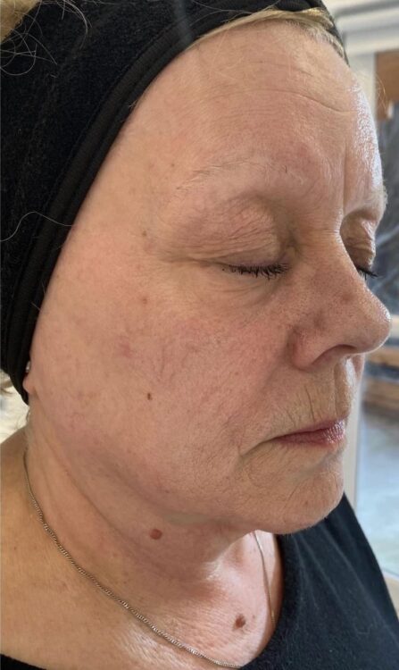before and after collagen lift b glam aesthetics