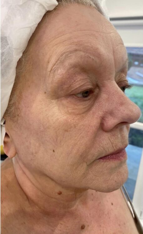 before and after collagen lift b glam aesthetics