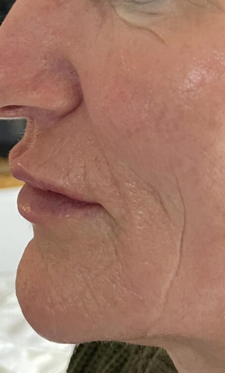 before and after collagen lift bijou beauty