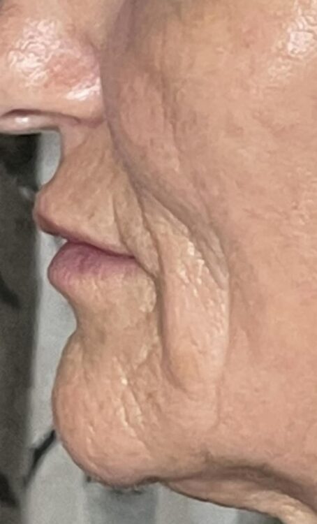 before and after collagen lift bijou beauty