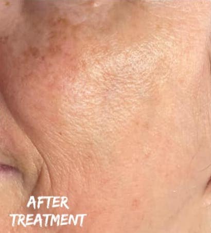 before and after collagen lift bijou beauty room