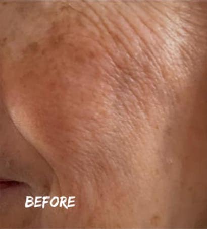 before and after collagen lift bijou beauty room
