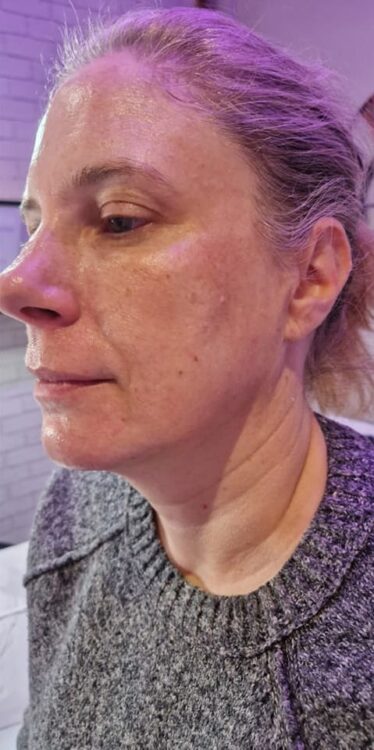 before and after collagen lift blissful beauty by Clare
