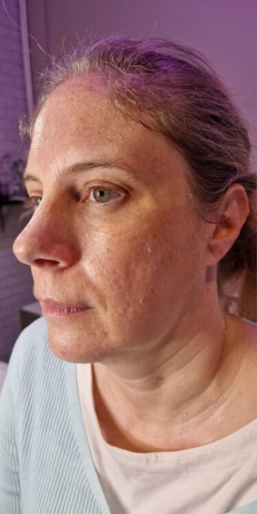 before and after collagen lift blissful beauty by Clare