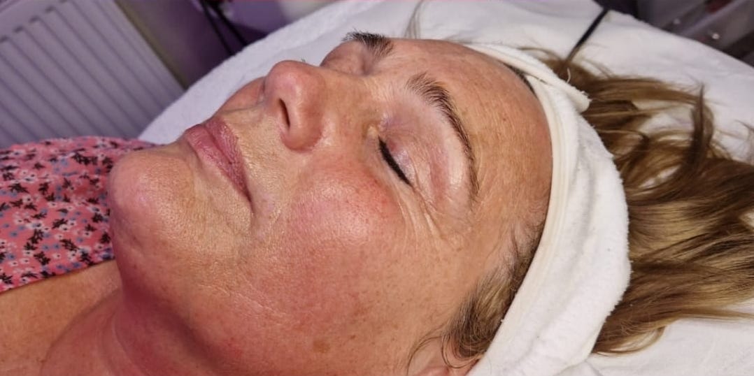 before and after collagen lift blissful beauty by Clare
