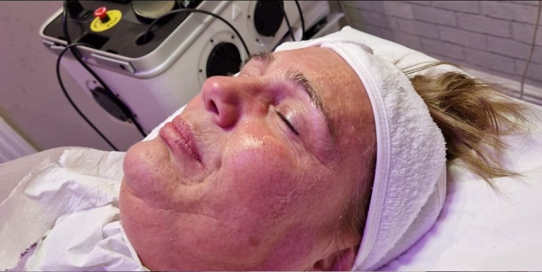 before and after collagen lift blissful beauty by Clare