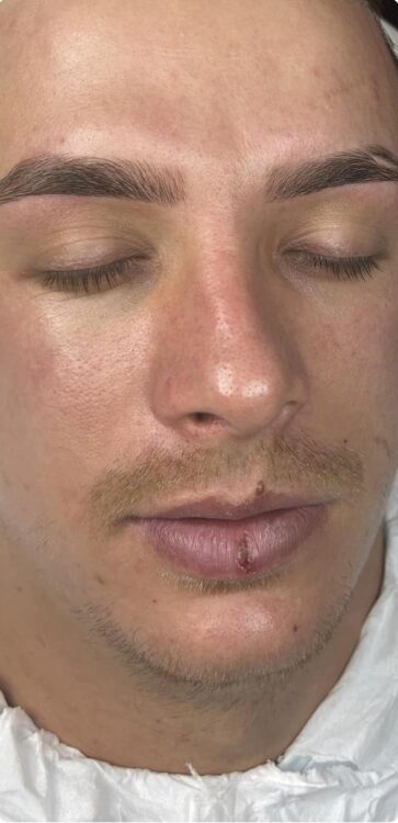 before and after microdermabrasion blondie hair and beauty