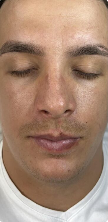 before and after microdermabrasion blondie hair and beauty