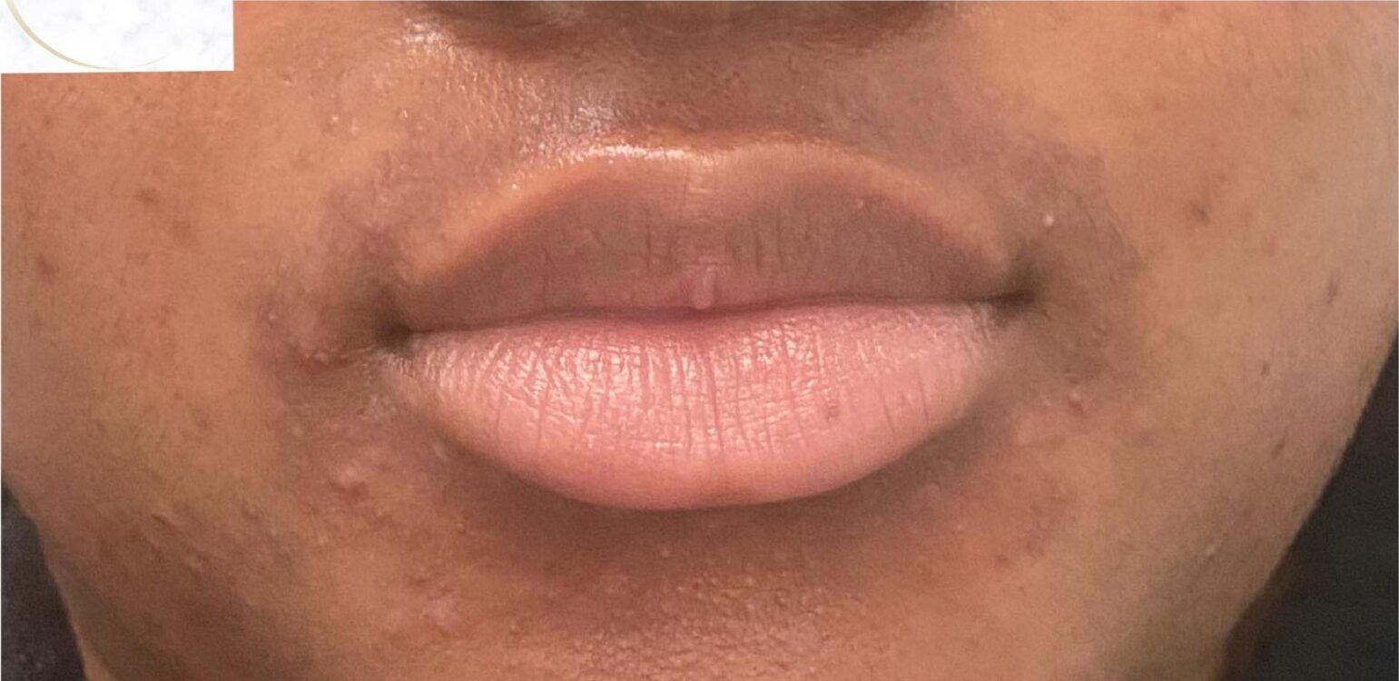 before and after microdermabrasion bodiology Sussex