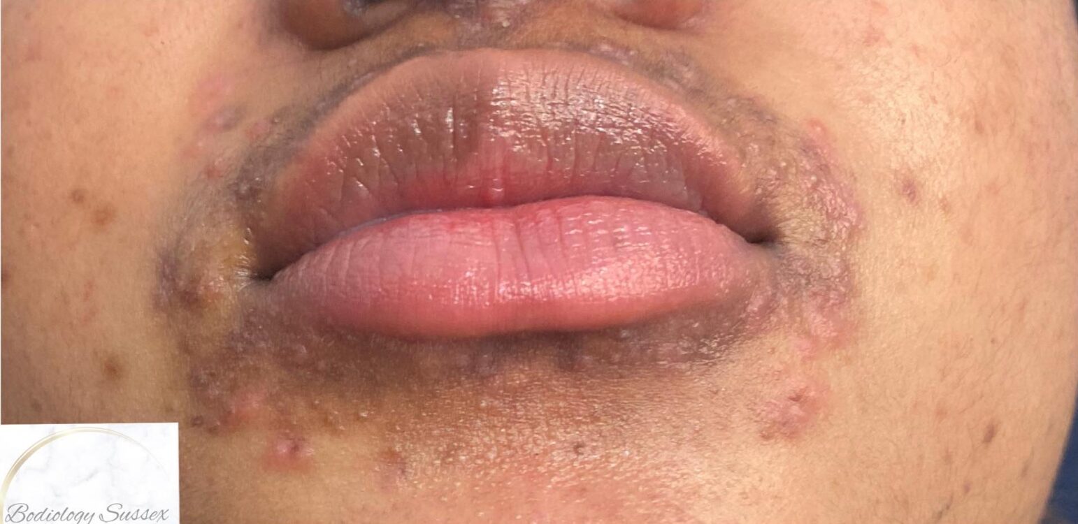 before and after microdermabrasion bodiology Sussex
