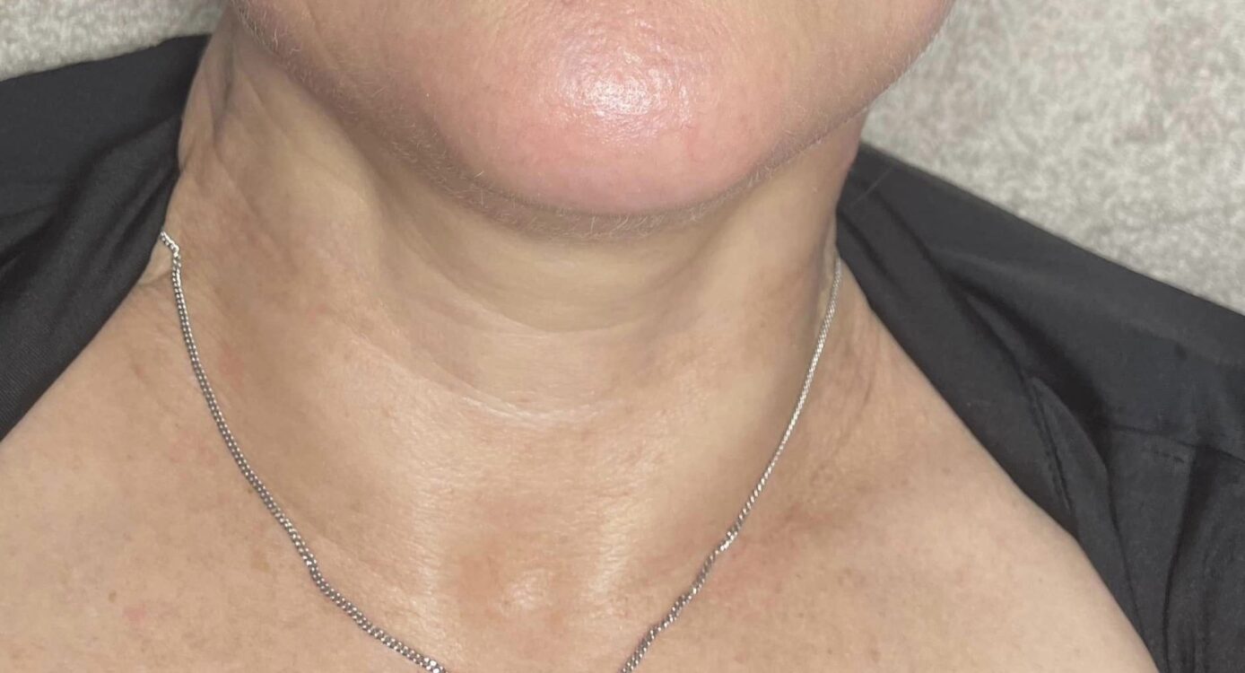 before and after collagen lift bodybliss