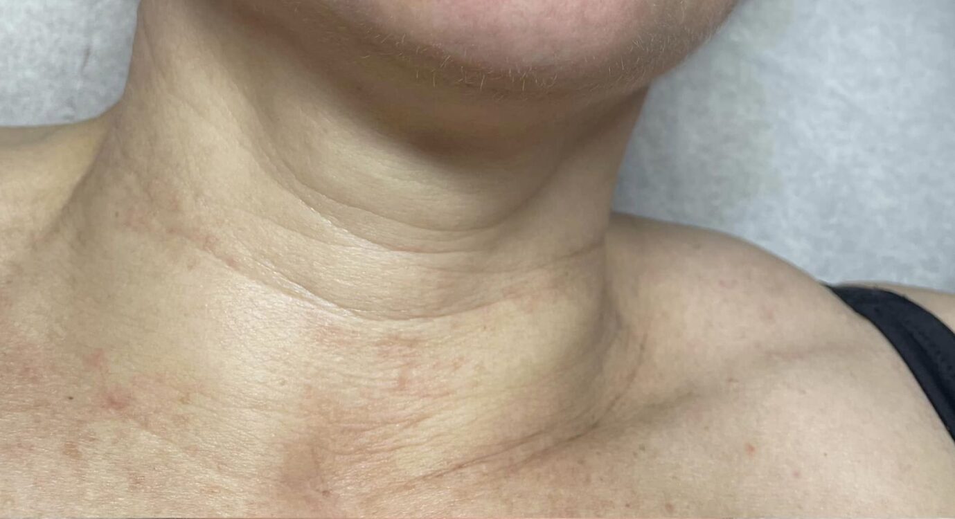 before and after collagen lift bodybliss
