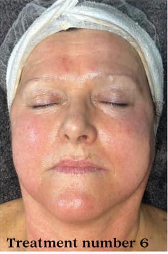 before and after collagen lift bronze inc