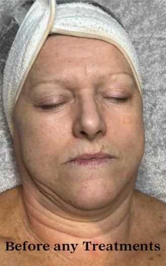 before and after collagen lift bronze inc