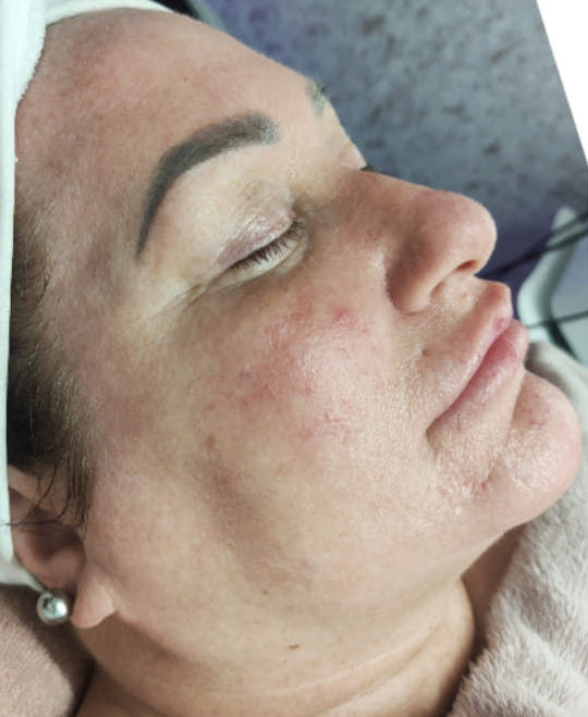 before and after ipl microdermabrasion Carla Amanda beauty
