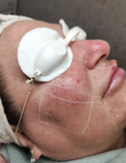 before and after ipl microdermabrasion Carla Amanda beauty