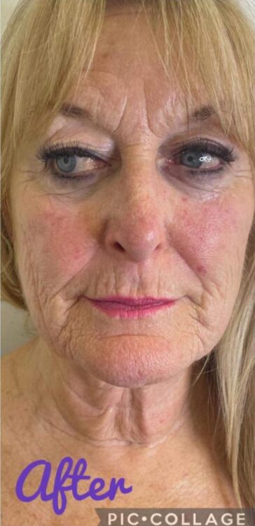 before and after collagen lift chasing perfections