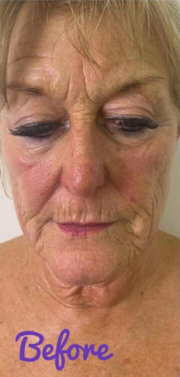 before and after collagen lift chasing perfections