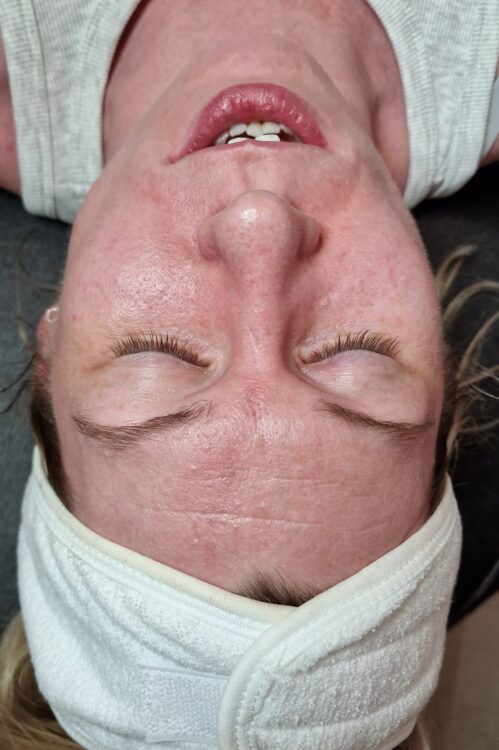 before and after microdermabrasion crystal's beauty