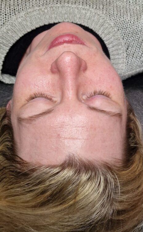 before and after microdermabrasion crystal's beauty