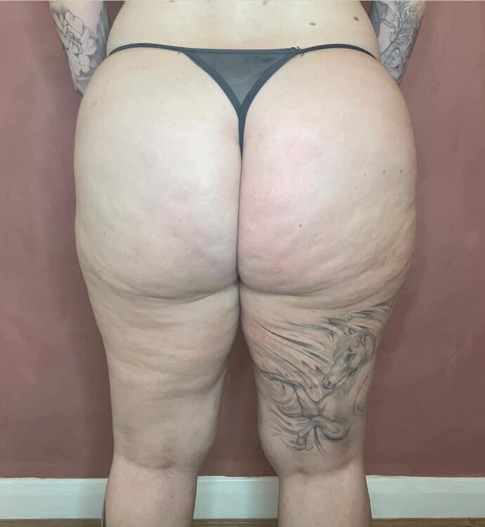 before and after collagen lift current beauty