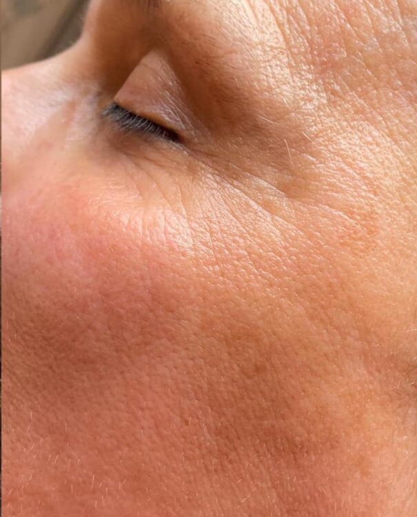 before and after collagen lift current beauty