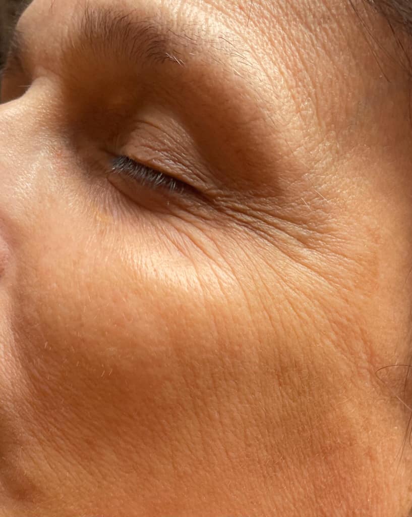 before and after collagen lift current beauty