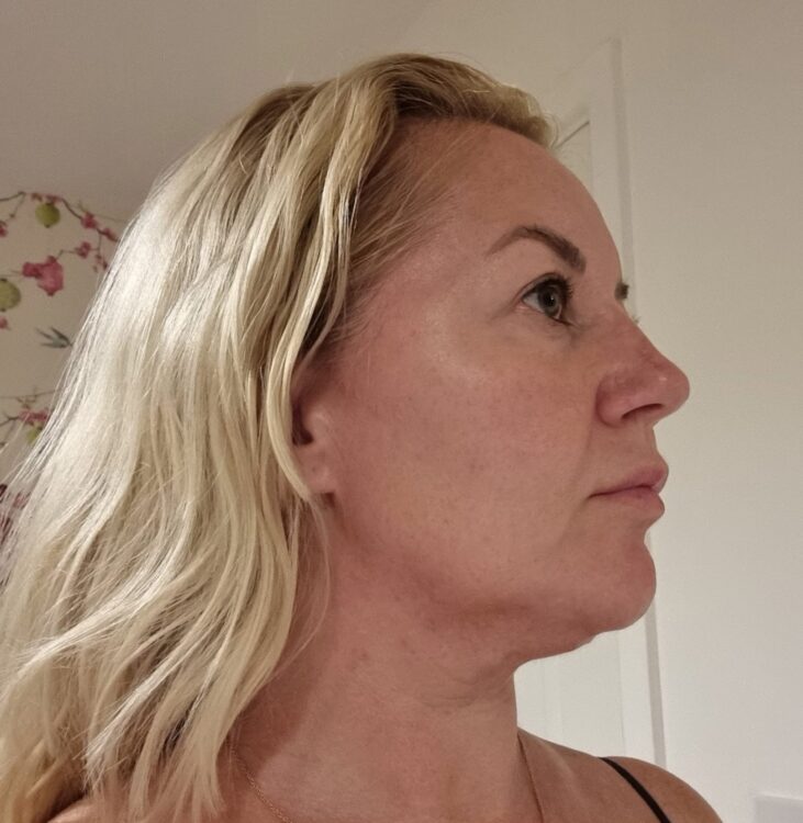 before and after collagen lift Danyel noon aesthetics