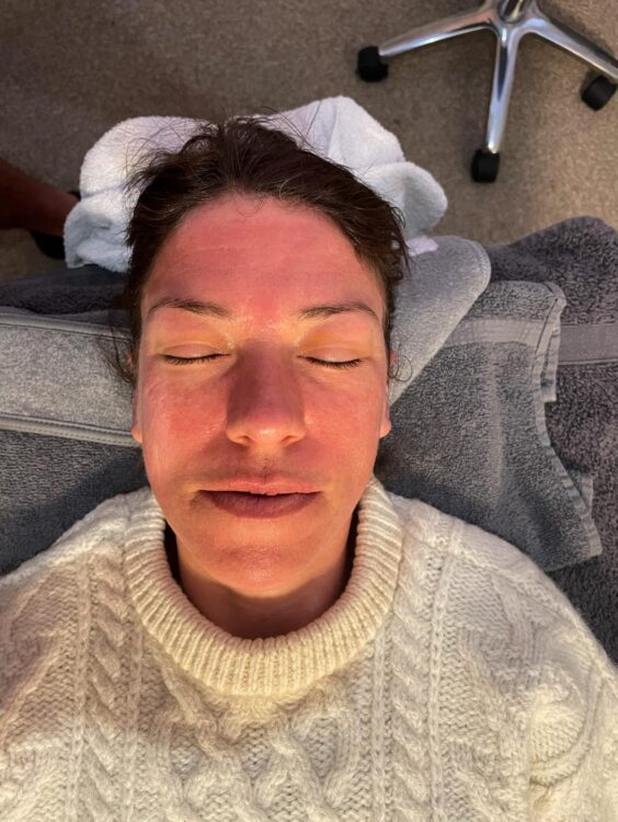 before and after microdermabrasion dv massage and skincare
