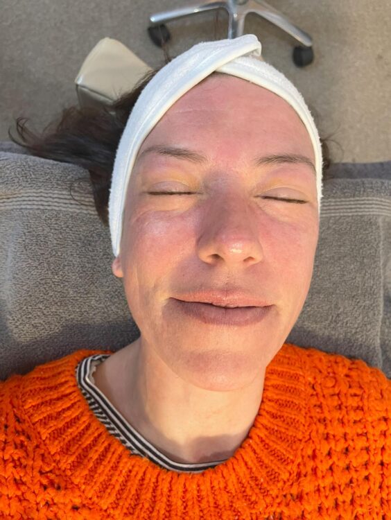 before and after microdermabrasion dv massage and skincare