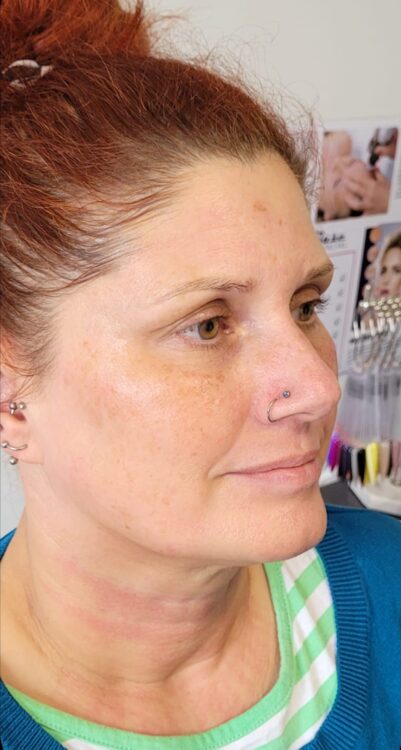 before and after microdermabrasion enhance nails and beauty