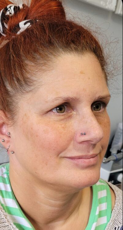 before and after microdermabrasion enhance nails and beauty