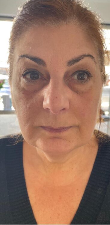before and after collagen lift friends hair and beauty