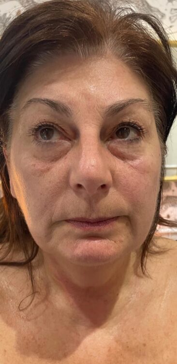 before and after collagen lift friends hair and beauty