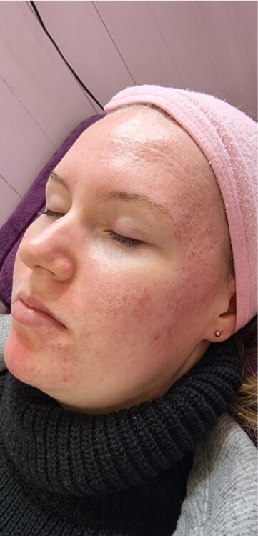 before and after collagen lift glam salon academy