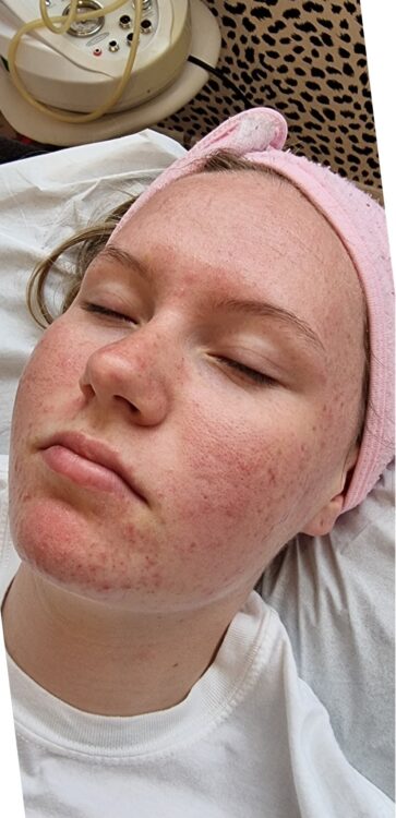 before and after collagen lift glam salon academy