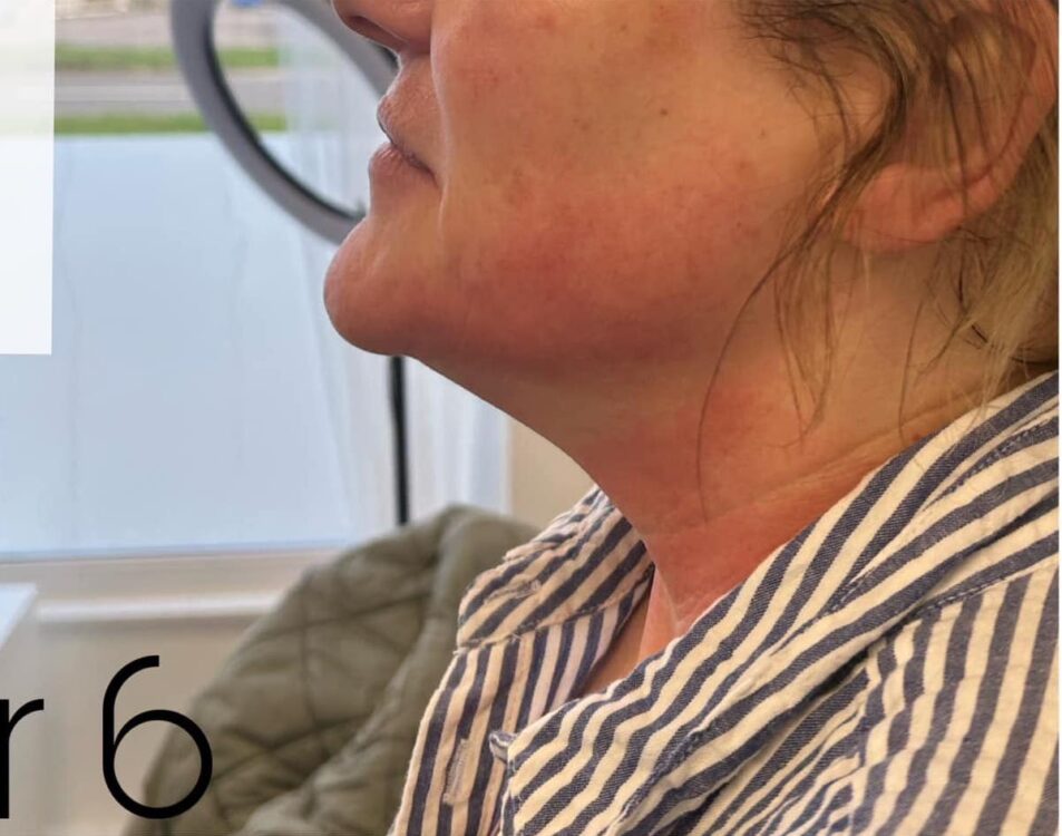 before and after collagen lift the hg clinic