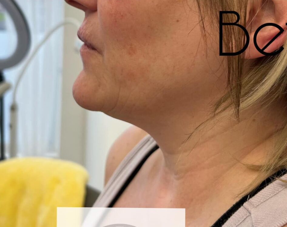 before and after collagen lift the hg clinic