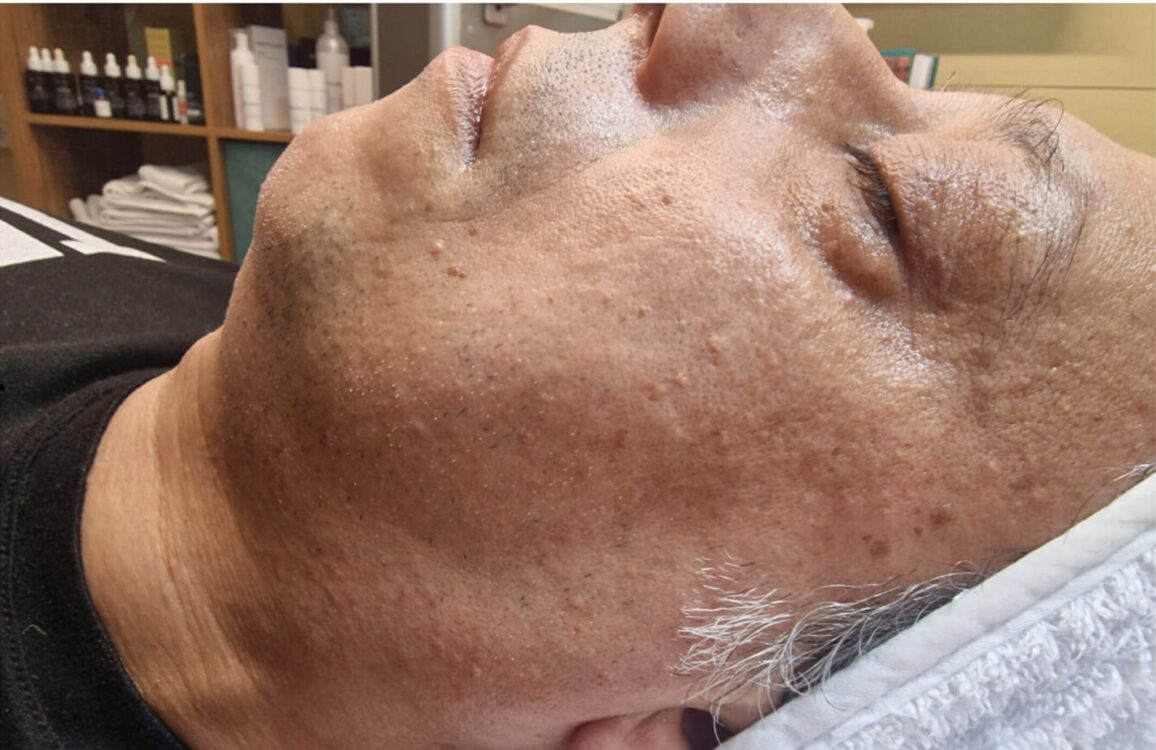 before and after collagen lift ice aesthetics