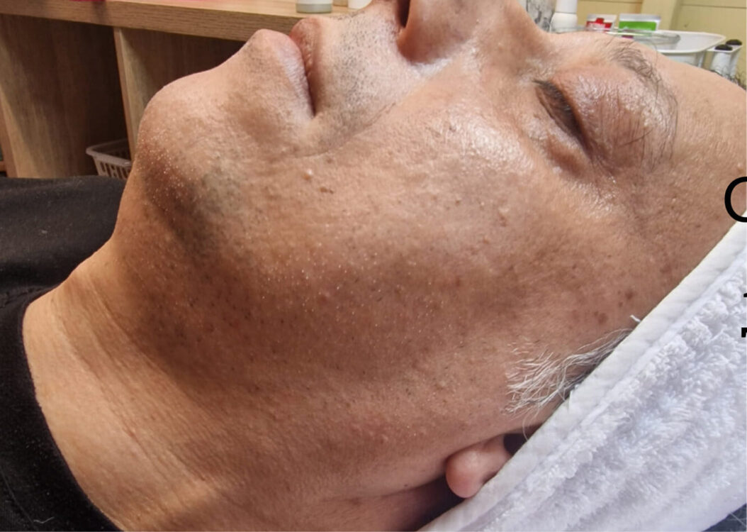 before and after collagen lift ice aesthetics