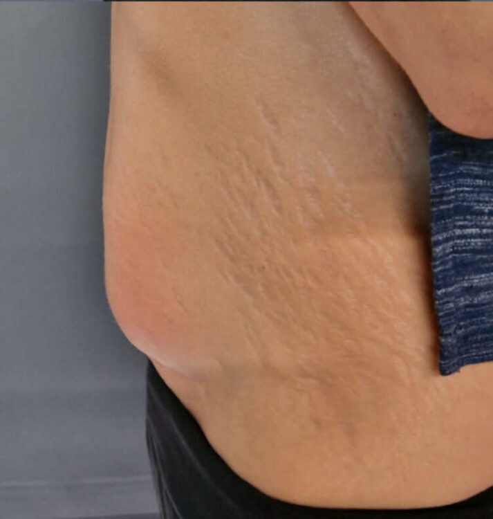 before and after collagen lift ice aesthetics