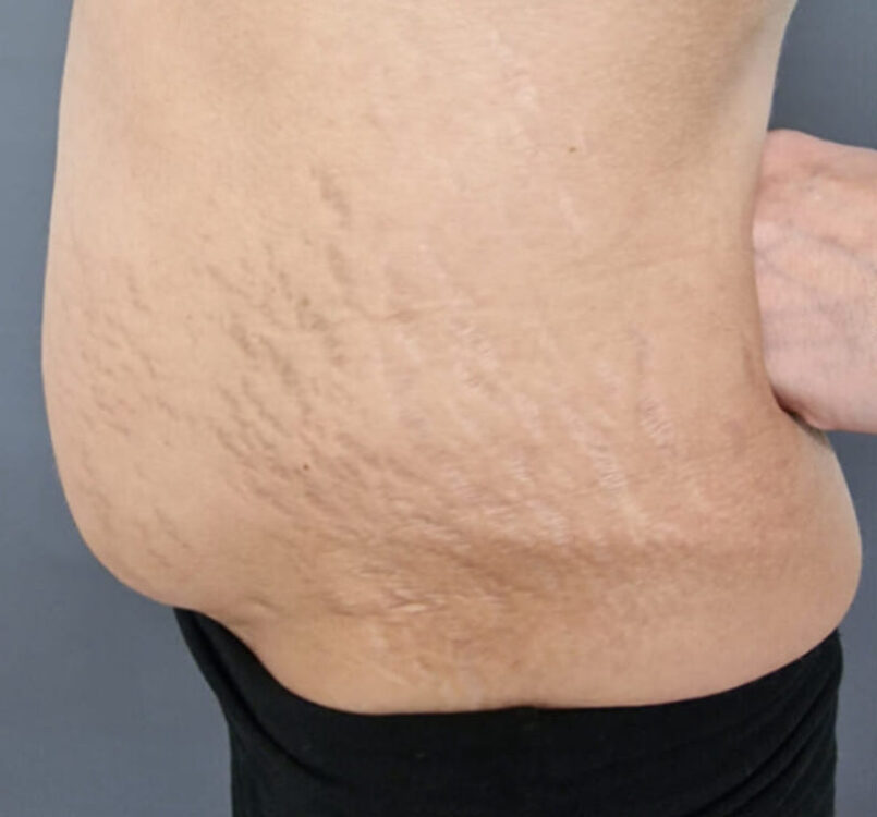 before and after collagen lift ice aesthetics