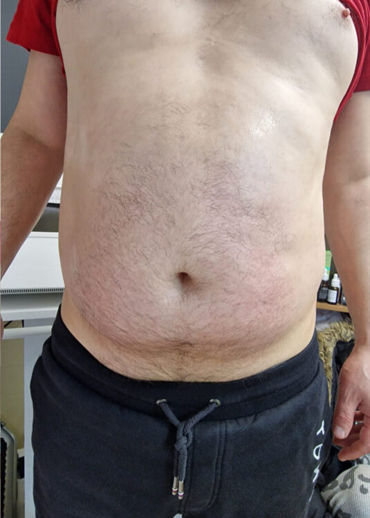 before and after collagen lift ice aesthetics
