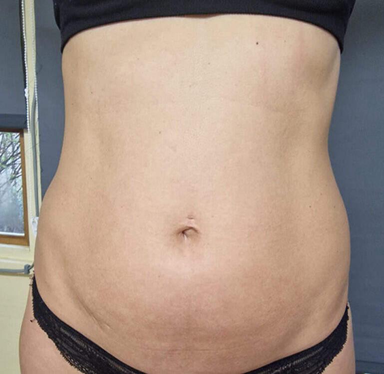 before and after collagen lift ice aesthetics
