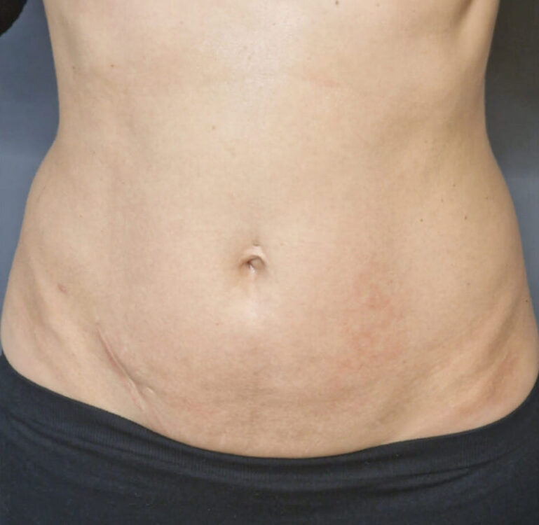 before and after collagen lift ice aesthetics