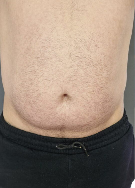 before and after collagen lift ice aesthetics