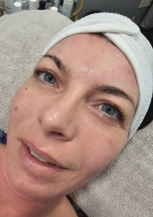 before and after microdermabrasion collagen lift iconic